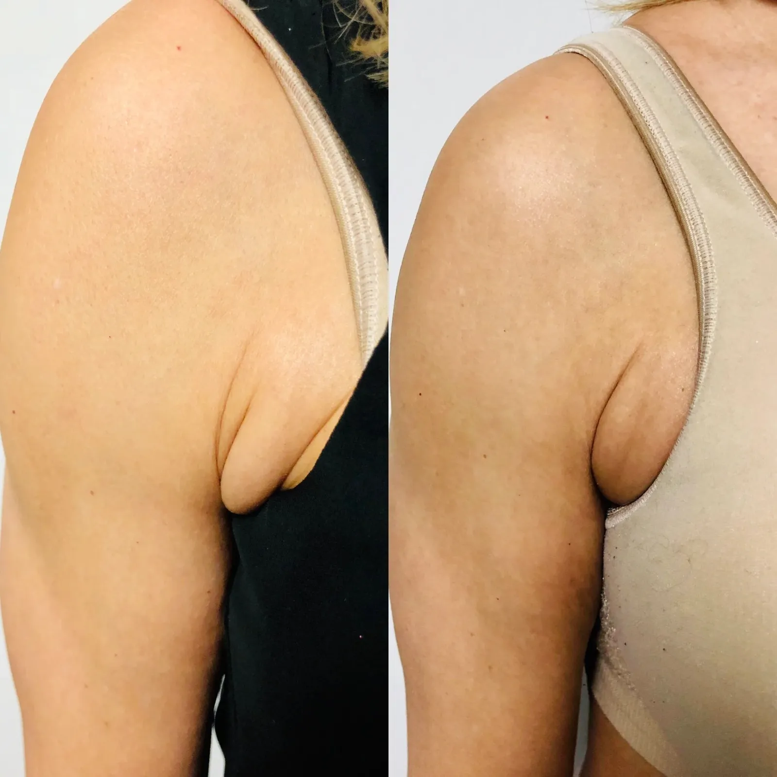 Benefits of Evolve Body Contouring